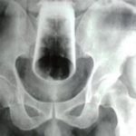 Homem enfia copo de vidro no ânus e objeto quebra dentro dele em MT