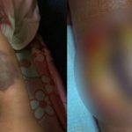 Menina de cinco anos perde parte do braço após receber medicação errada em UPA de Sorriso