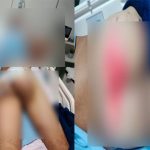 Paciente faz cirurgia no nariz e tem nádegas queimadas em hospital de MT