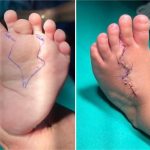 Bebê que nasceu com o ‘pé duplicado’ em MT passa por cirurgia inédita no Brasil