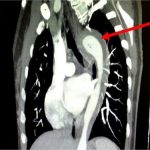 Mulher rompe aorta após orgasmo e sobrevive a condição rara e potencialmente fatal