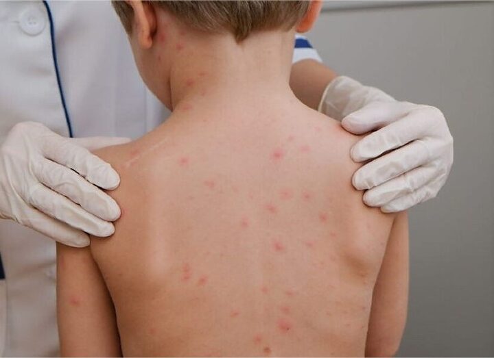 Cuiabá registra sete casos de meningite em 2026 e não confirma novos diagnósticos desde abril