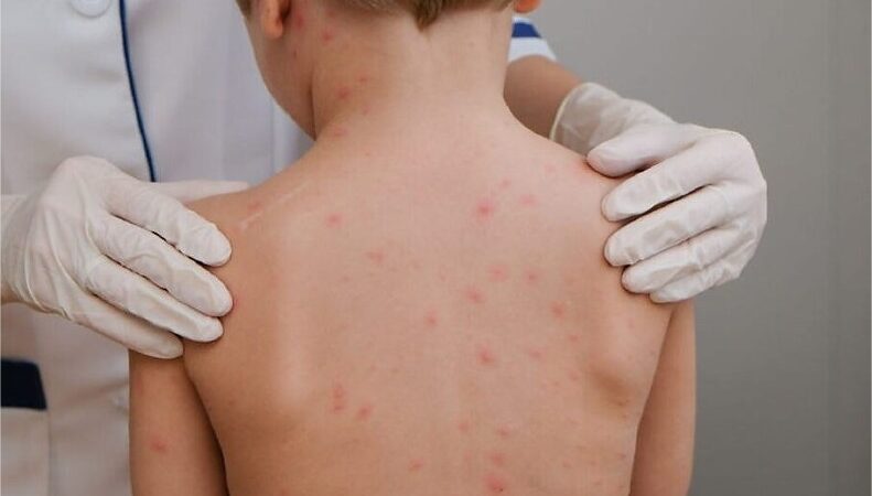 Cuiabá registra sete casos de meningite em 2026 e não confirma novos diagnósticos desde abril