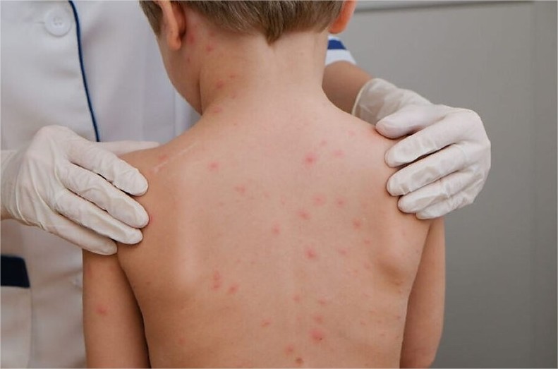 Cuiabá registra sete casos de meningite em 2026 e não confirma novos diagnósticos desde abril