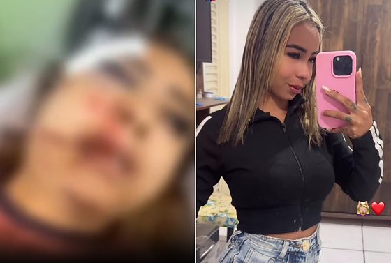 Garota de programa espancada por cliente em VG teve a mandíbula quebrada e família pede ajuda